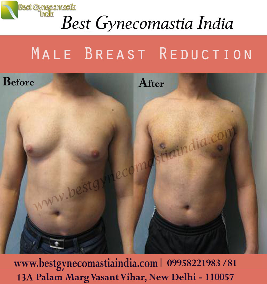 Gynecomastia Surgery (Male Breast Reduction) Cost and Reviews in Malaysia  2022
